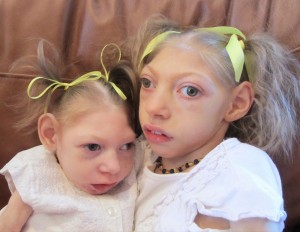 microcephalic.girls